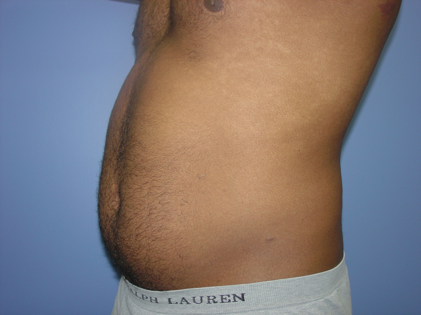 1_Liposuction-Patient-1_