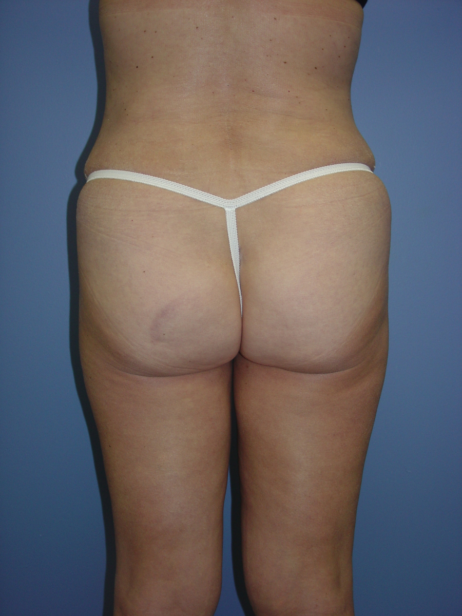 1_Liposuction-Patient-2-