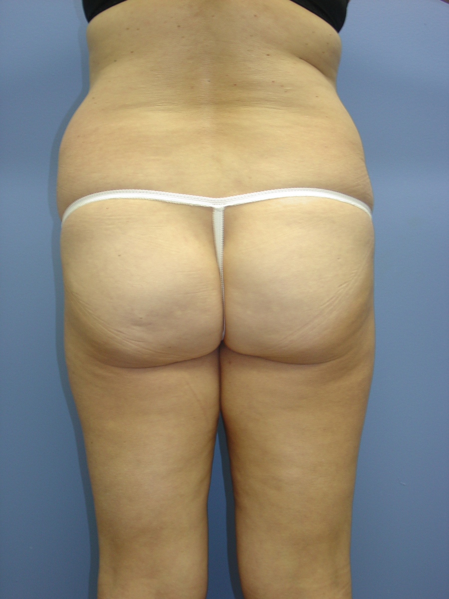 1_Liposuction-Patient-2-1