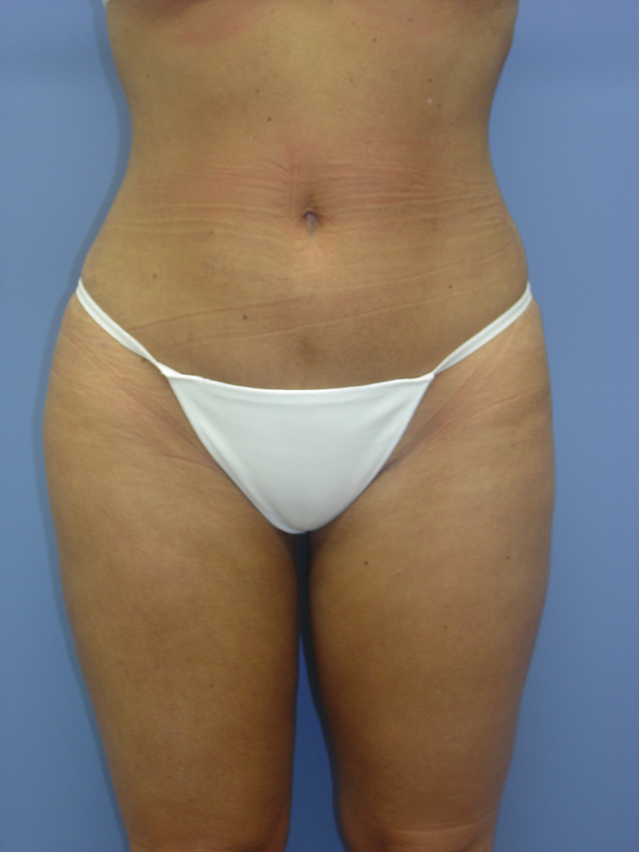 1_Liposuction-Patient-3-