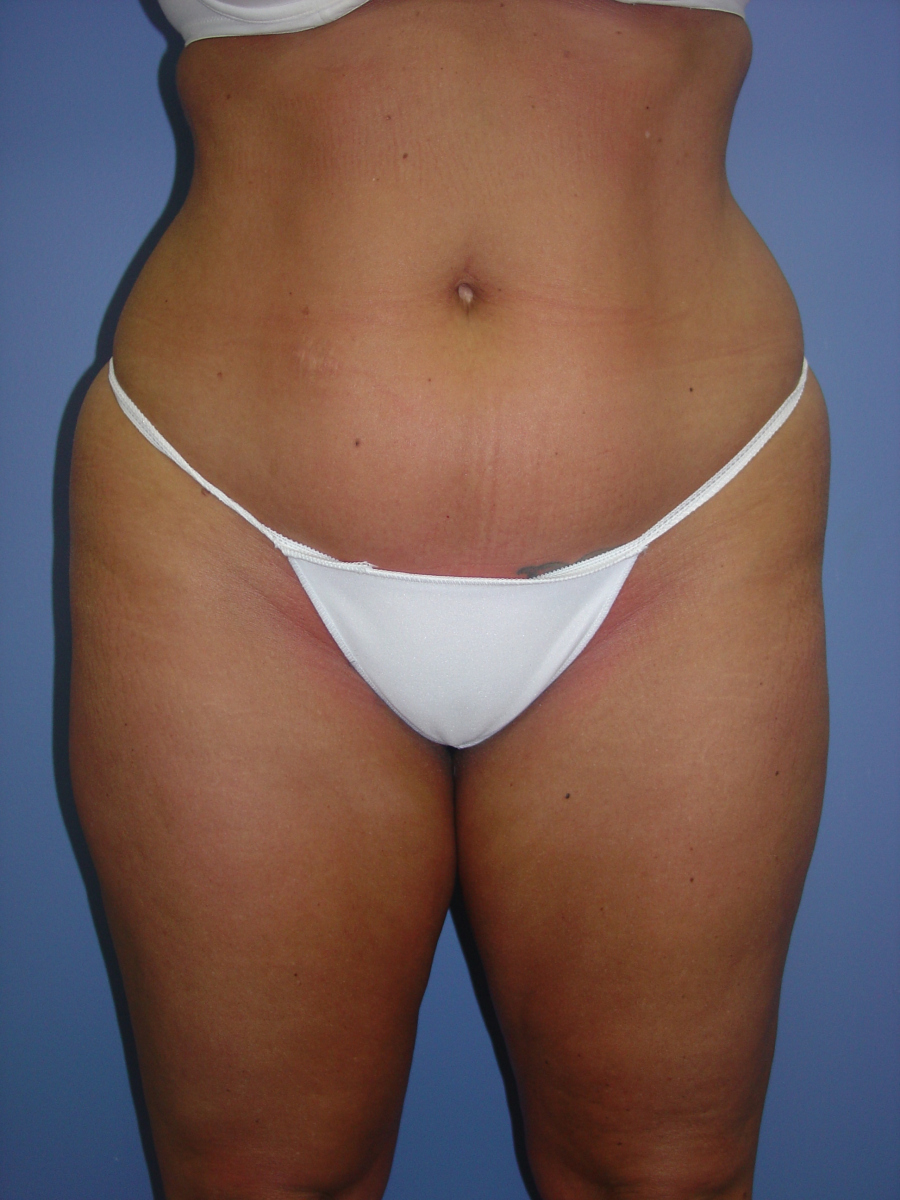 1_Liposuction-Patient-3-2