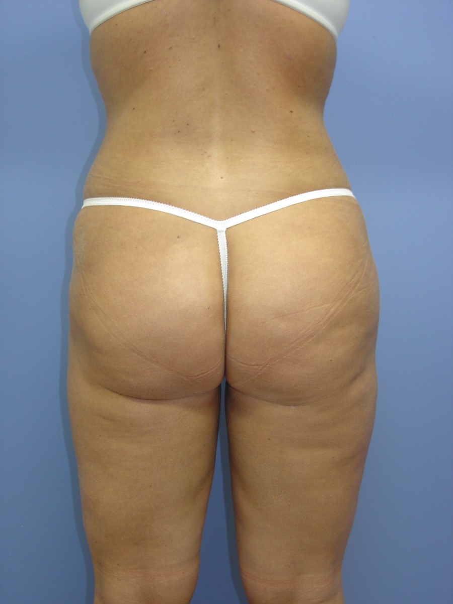 1_Liposuction-Patient-3