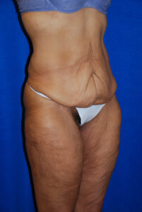 A person with loose skin around the abdomen and thighs stands against a blue background, wearing a bra and underwear.