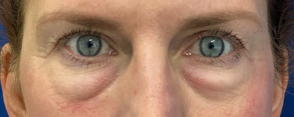 Close-up of a person's eyes showing signs of puffiness and dark circles beneath them. The skin appears slightly wrinkled.