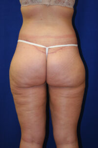 A person in underwear is standing in front of a blue background, showing their back and legs.