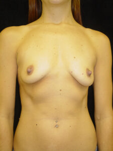 The image shows a person from the neck to waist, facing forward, with visible piercings and moles on their torso.