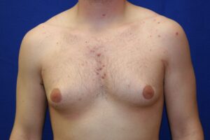 Bare male torso with visible acne and blemishes on the chest, shoulders, and upper arms against a blue background.