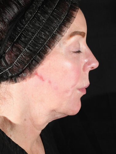 Profile view of a person’s face showing a healing linear incision along the jawline.
